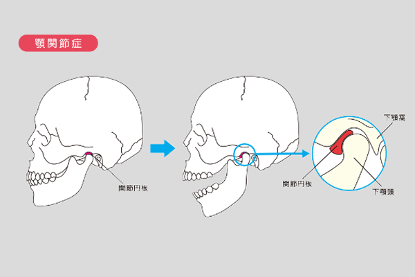 顎関節症のイメージ図